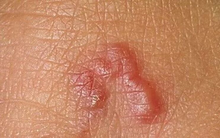 parasit handapeun kulit manusa