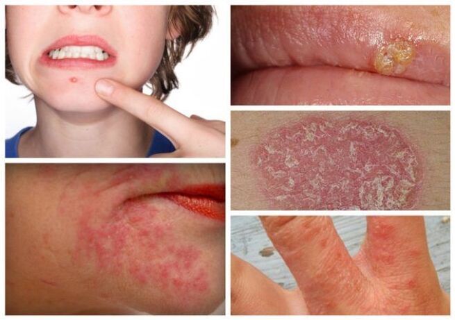 Alergi sareng panyakit kulit mangrupikeun tanda parasit dina awak